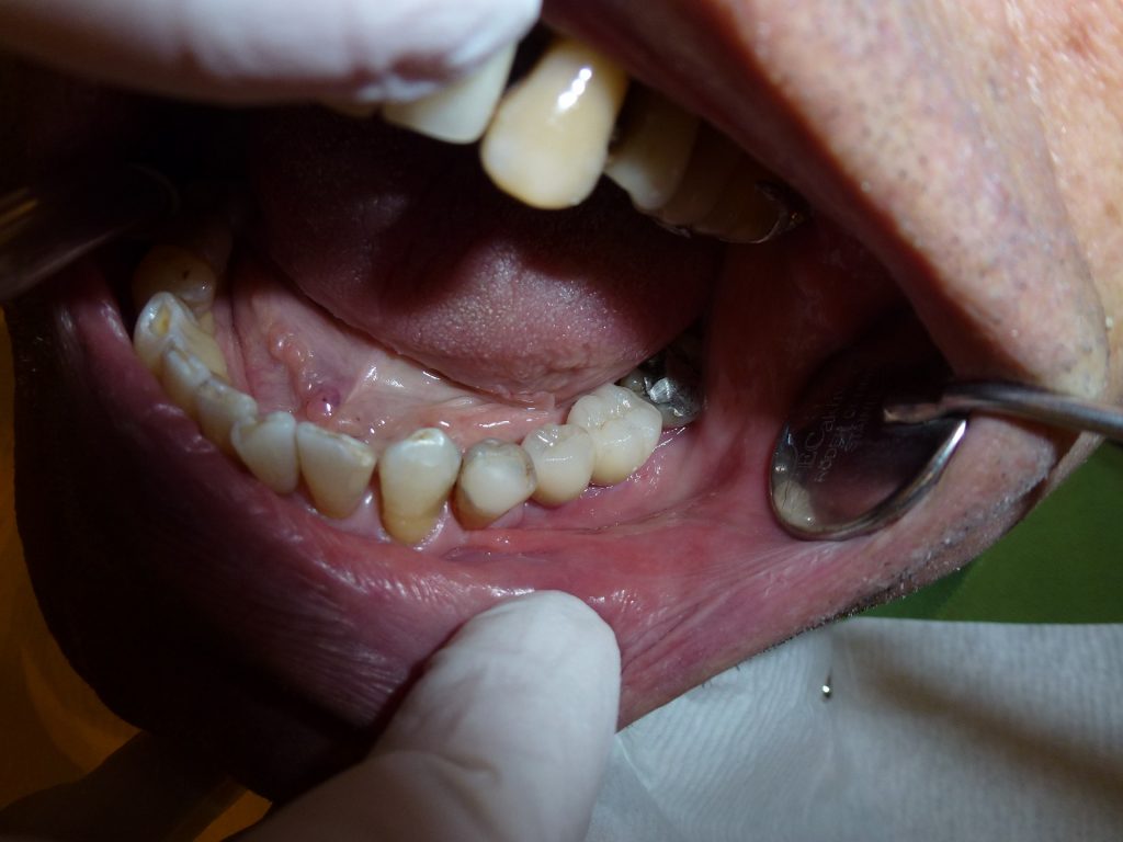 Dureri articulare după tratamentul dinților Extracţia dentară