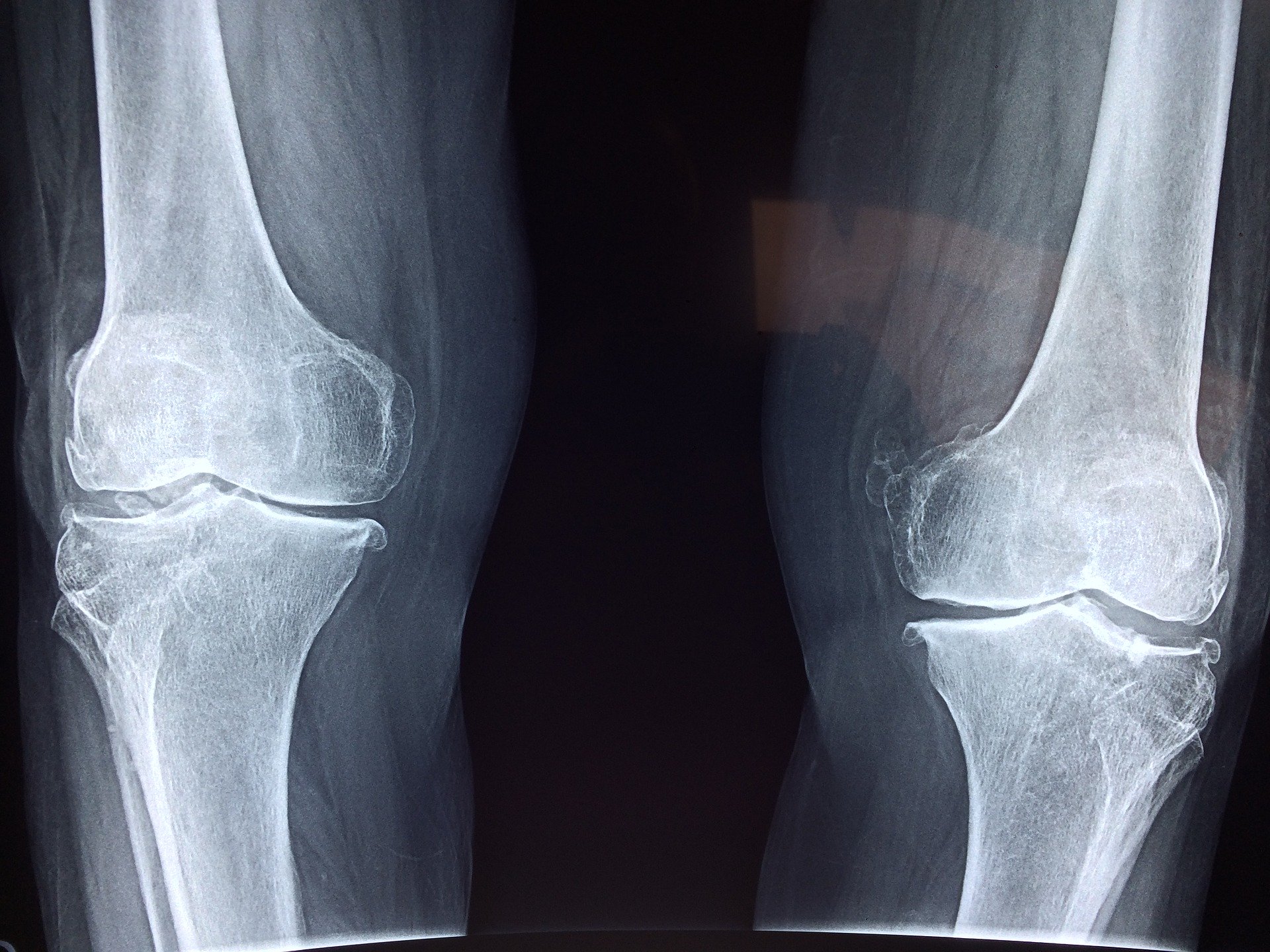 durere dureroasă în articulația genunchiului stâng tratamentul artritei reactive